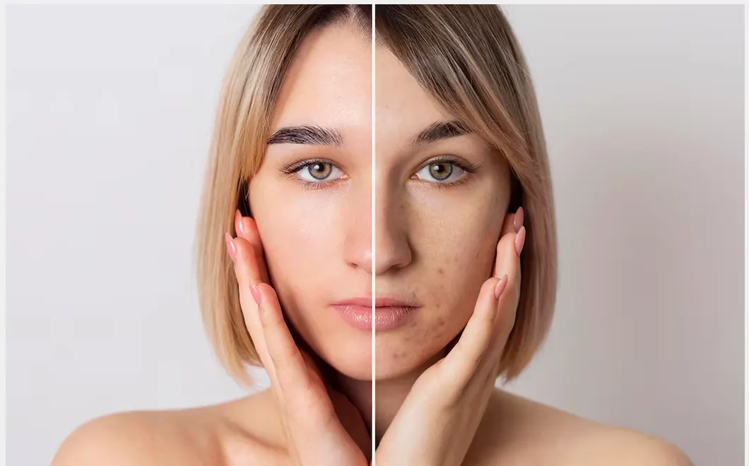 ৩০ ঘরোয়া উপায়ে দ্রুত দূর হবে ব্রণের দাগ? জেনে নিন সহজেই!!