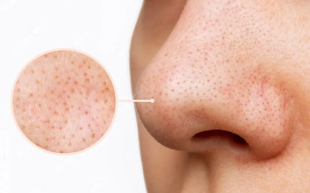 ব্ল্যাকহেডসের যন্ত্রণা বারবার?জেনে নিন ঘরোয়া সহজ কিছু টিপস