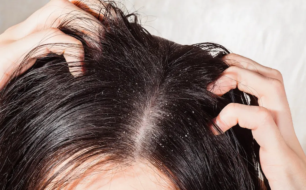 খুশকি কেনো হয়?কিভাবে দূর করবেন খুশকি?জেনে নিন সহজ উপায়