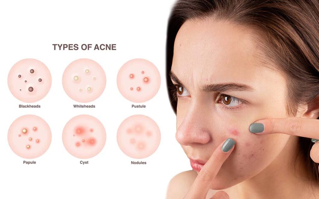 ব্রণ কি কি ধরনের হতে পারে