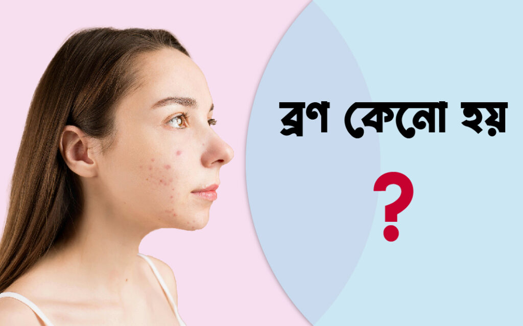 ব্রণ কেনো হয়