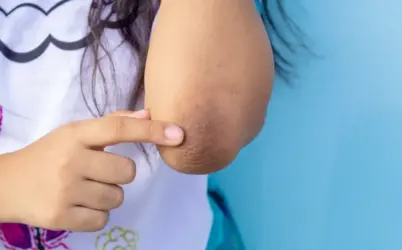 কনুই এর কালো দাগ